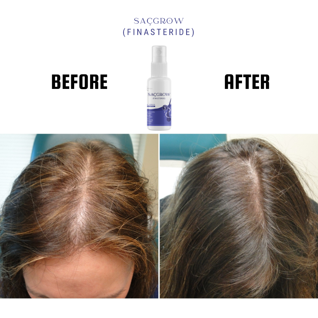 Saçgrow (Finasteride) Serum