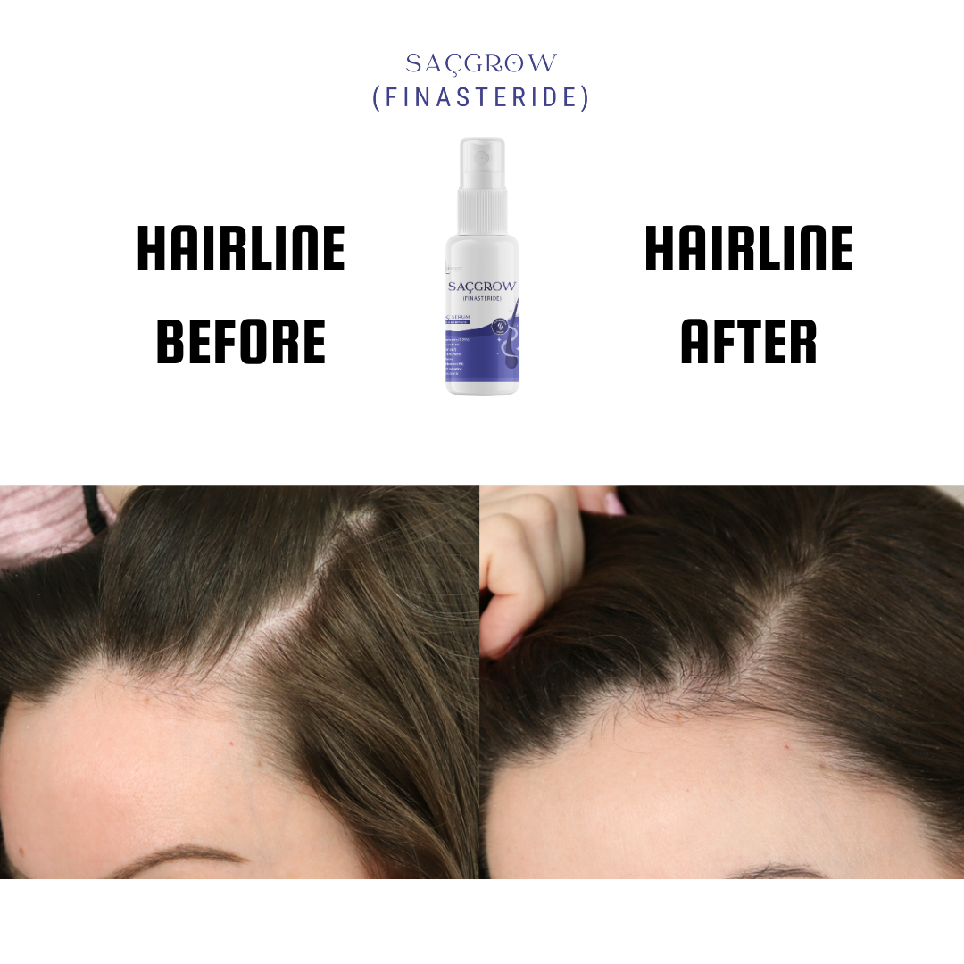Saçgrow (Finasteride) Serum
