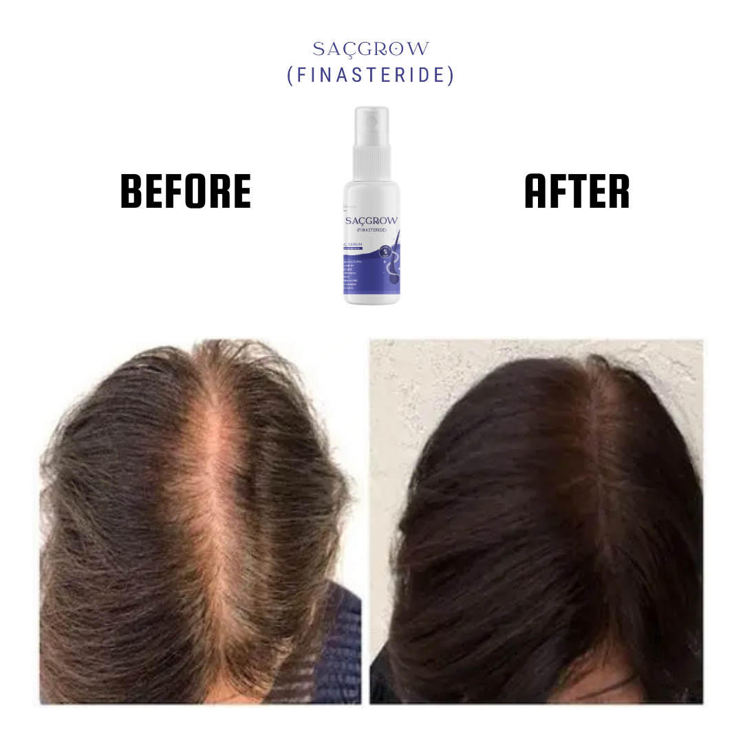 Saçgrow (Finasteride) Serum