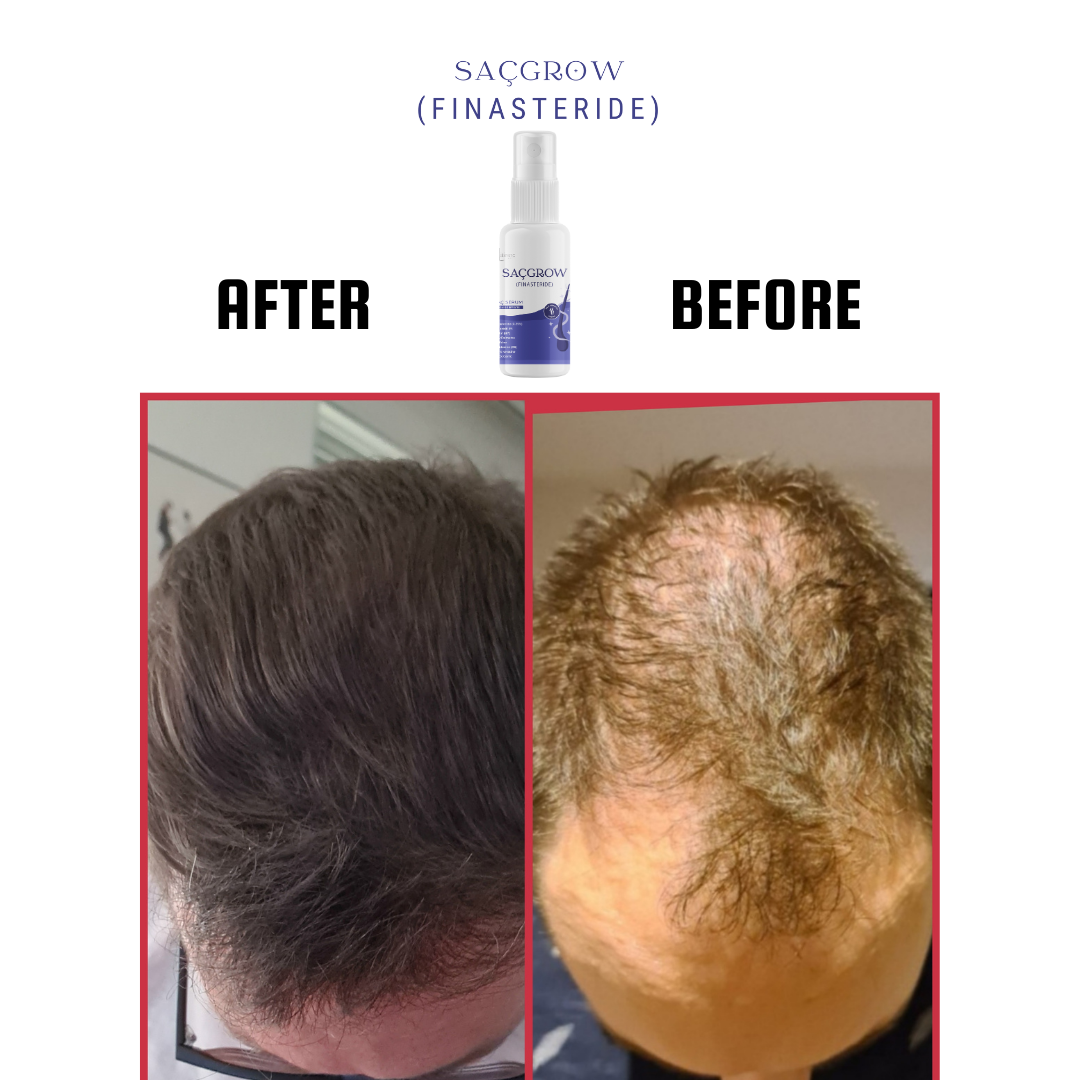 Saçgrow (Finasteride) Serum