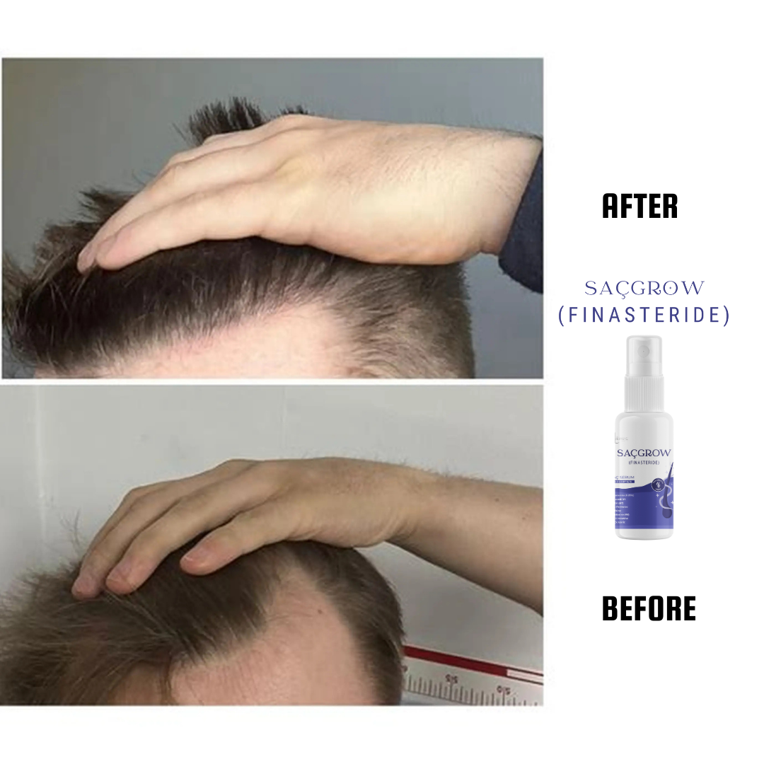Saçgrow (Finasteride) Serum
