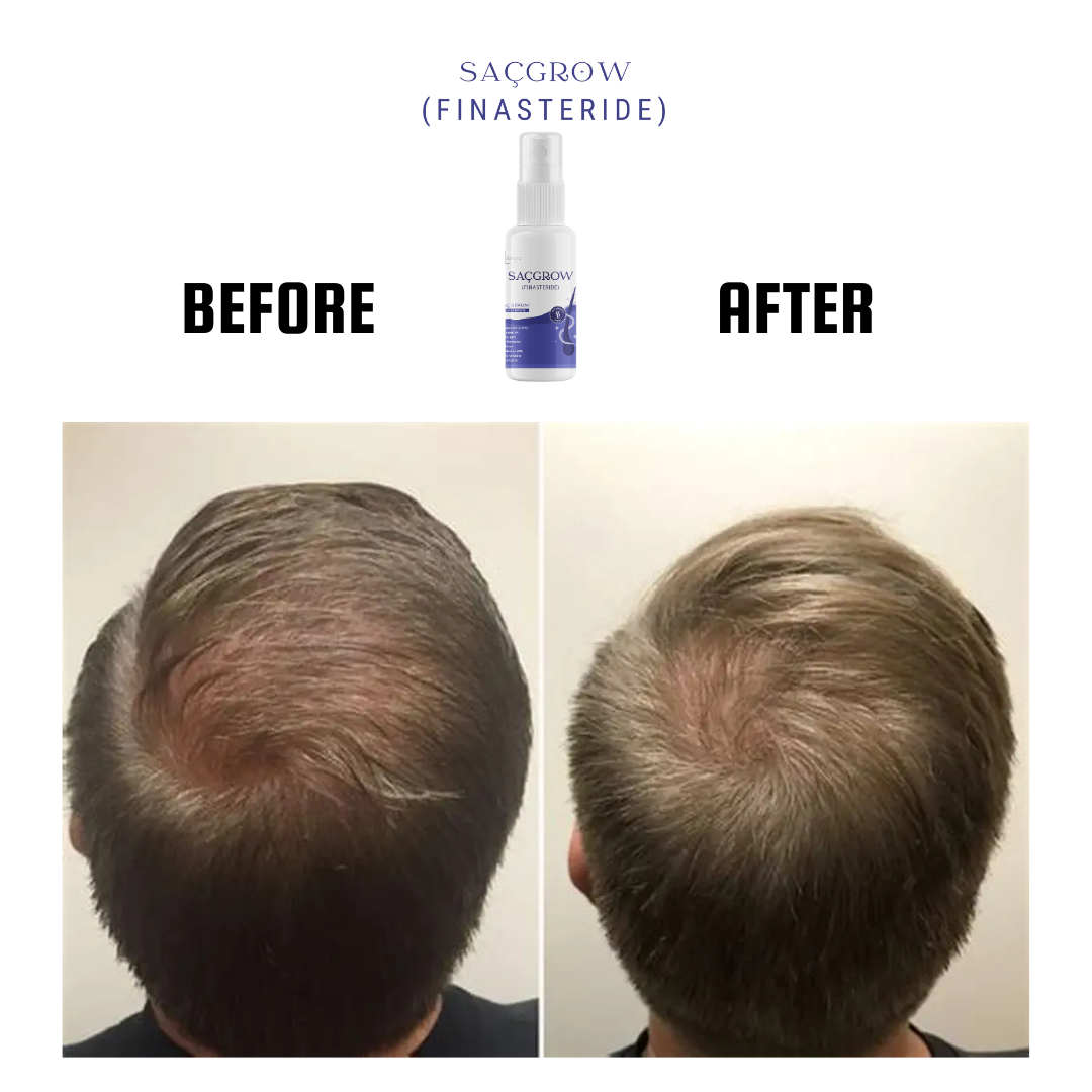 Saçgrow (Finasteride) Serum